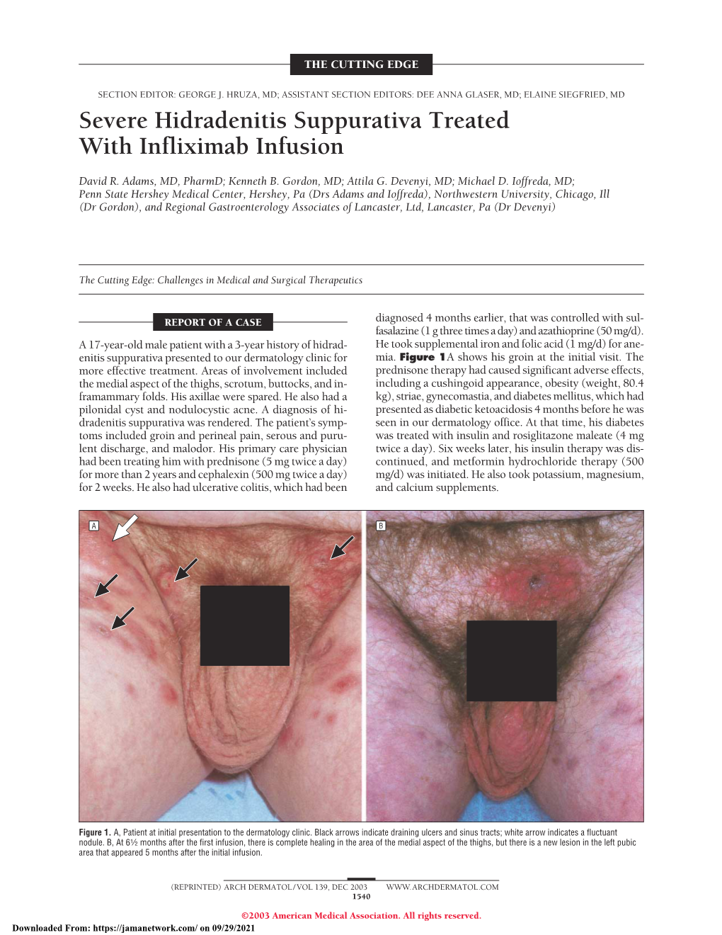 Severe Hidradenitis Suppurativa Treated with Infliximab Infusion