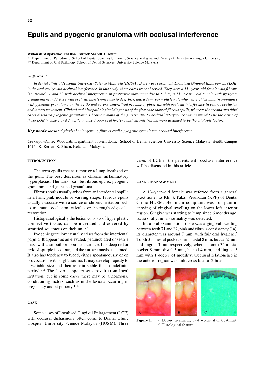 Epulis and Pyogenic Granuloma with Occlusal Interference