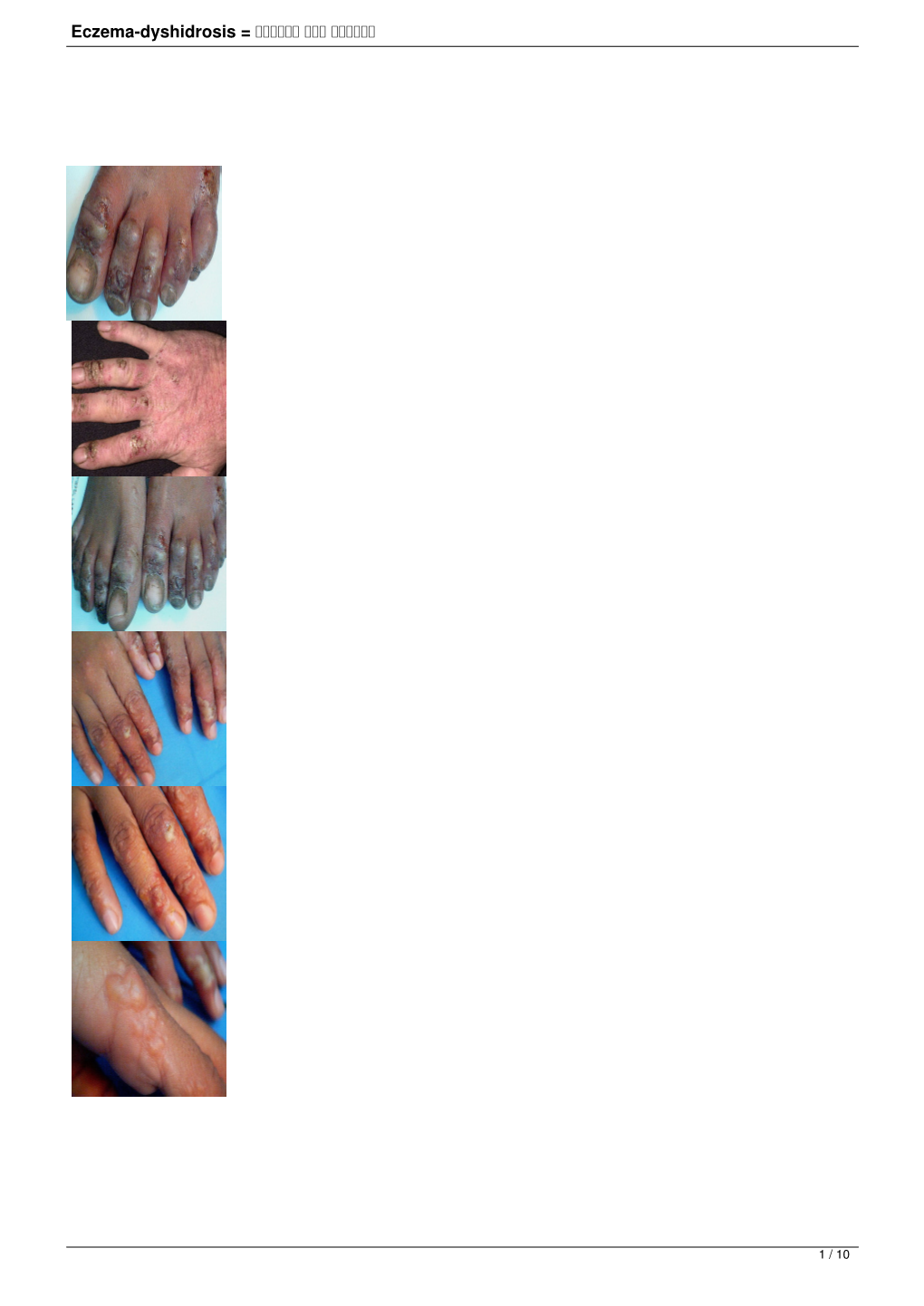 Eczema-Dyshidrosis = اكزيمة عسر التعرق