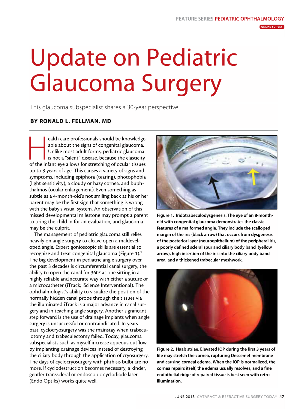 Update on Pediatric Glaucoma Surgery