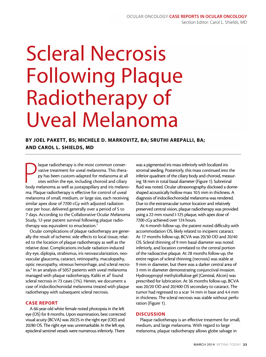 Scleral Necrosis Following Plaque Radiotherapy of Uveal Melanoma