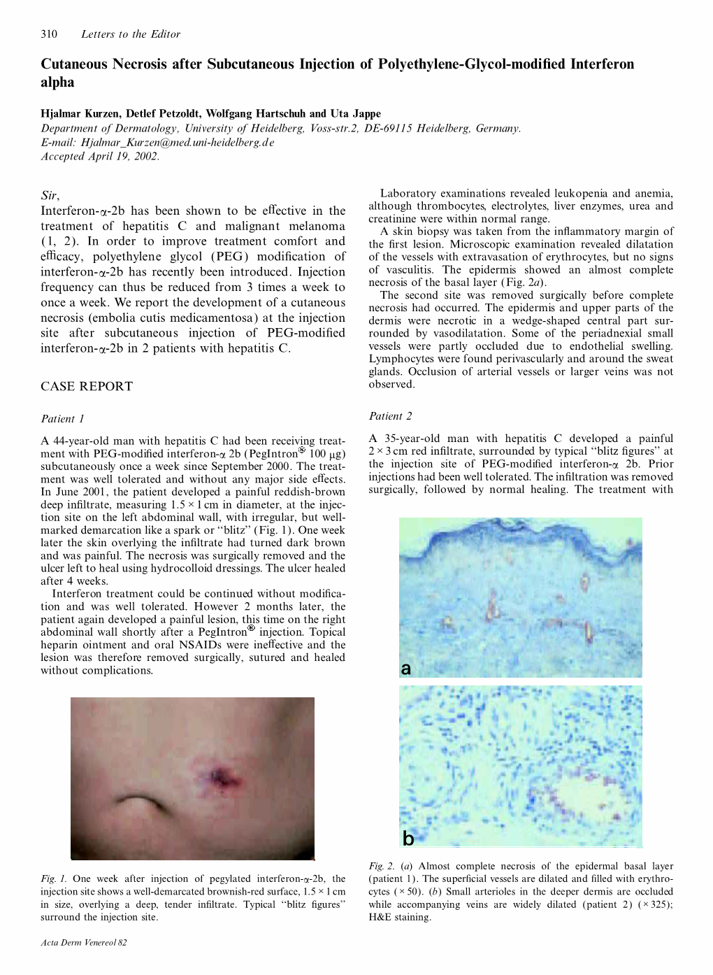 Cutaneous Necrosis After Subcutaneous Injection of Polyethylene-Glycol-Modi Ed Interferon Alpha