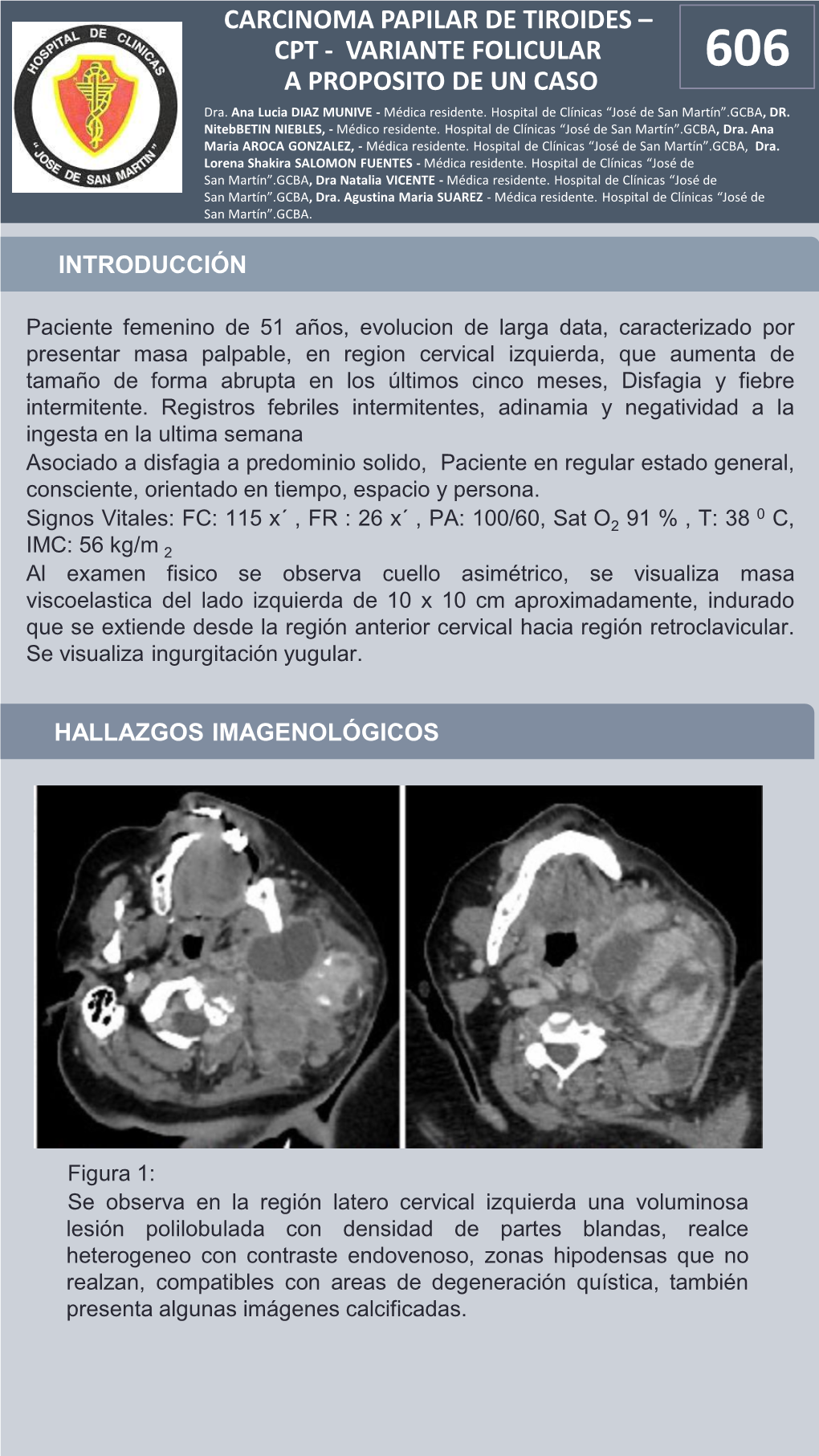 CARCINOMA PAPILAR DE TIROIDES – CPT - VARIANTE FOLICULAR 606 a PROPOSITO DE UN CASO Dra