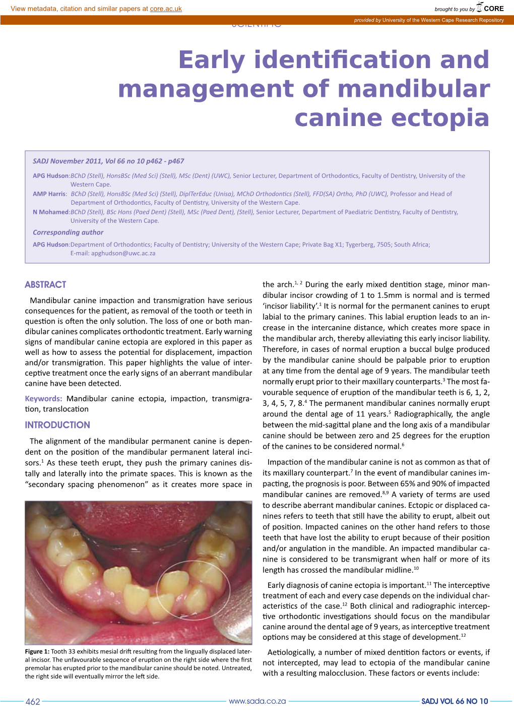 Early Identification and Management of Mandibular Canine Ectopia