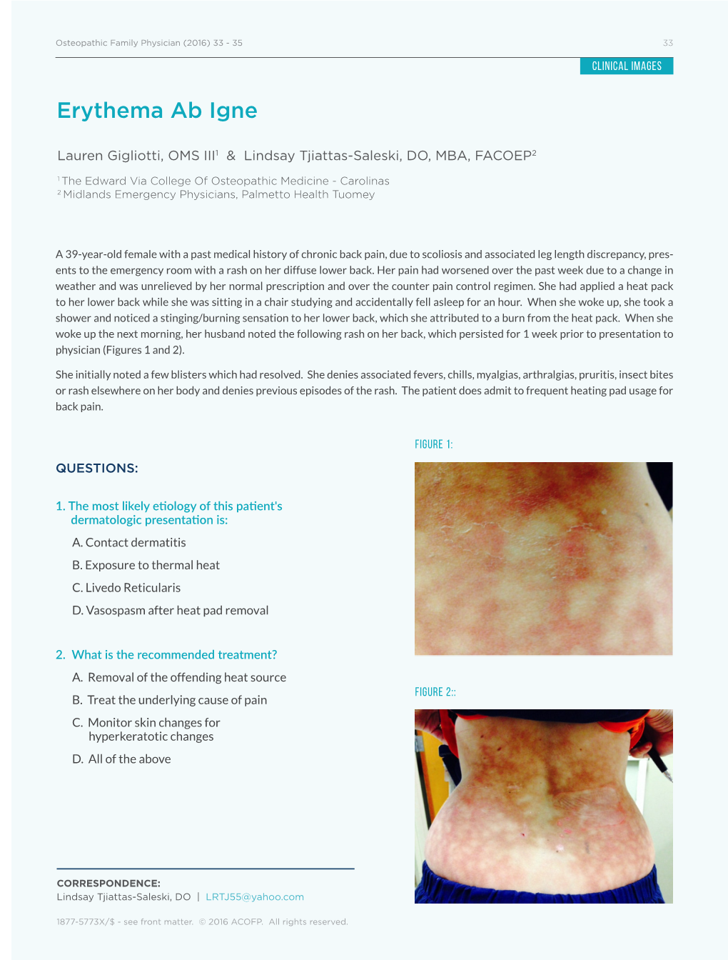 Erythema Ab Igne