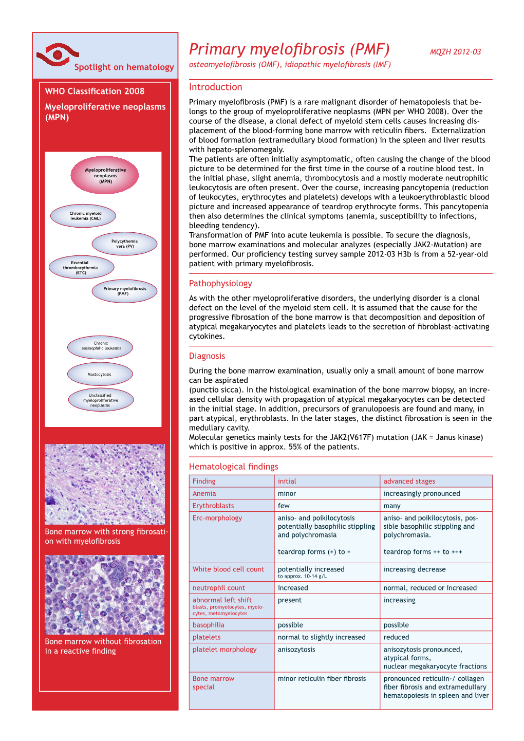 Primary Myelofibrosis (PMF) Spotlight on Hematology Osteomyelofibrosis (OMF), Idiopathic Myelofibrosis (IMF)