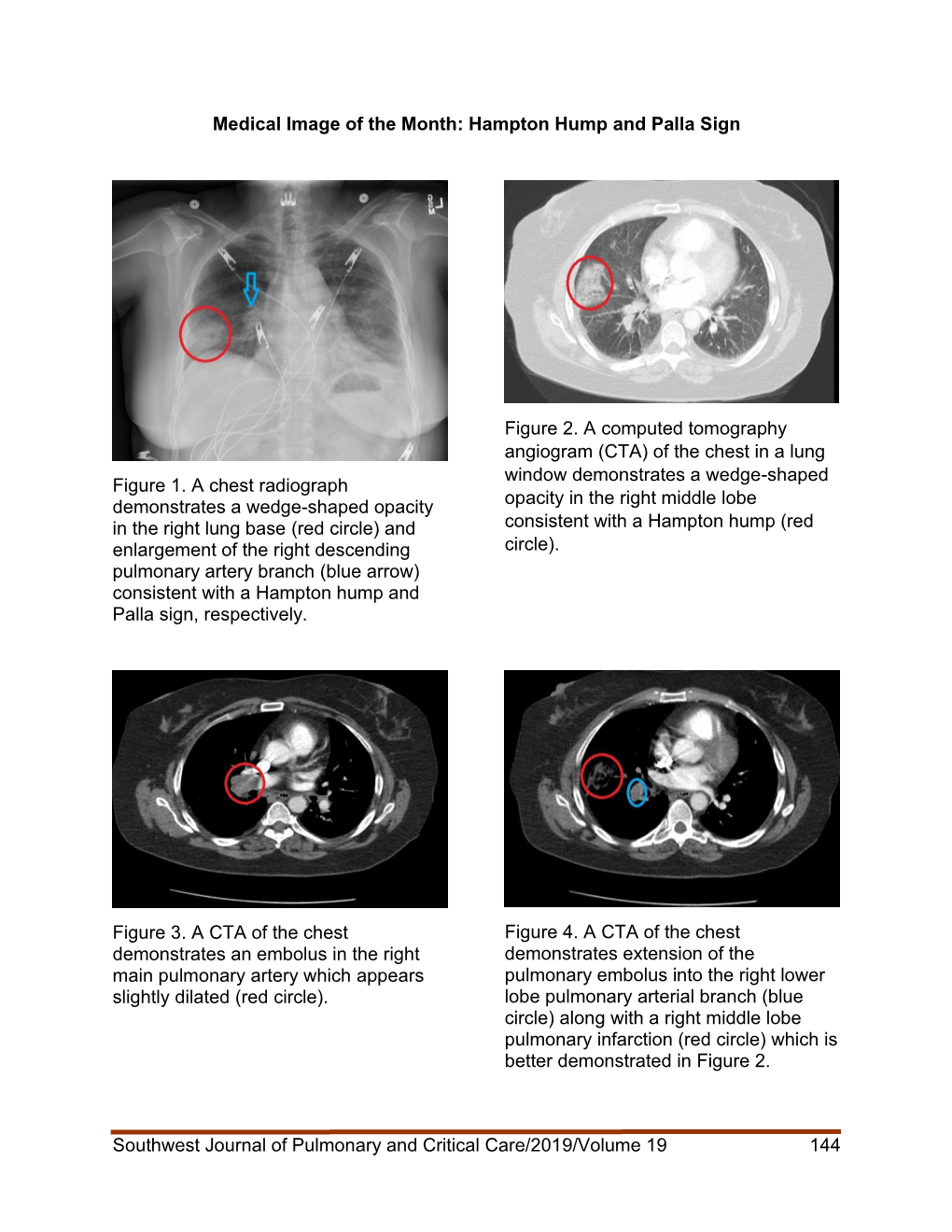 Southwest Journal of Pulmonary and Critical Care/2019/Volume 19 144