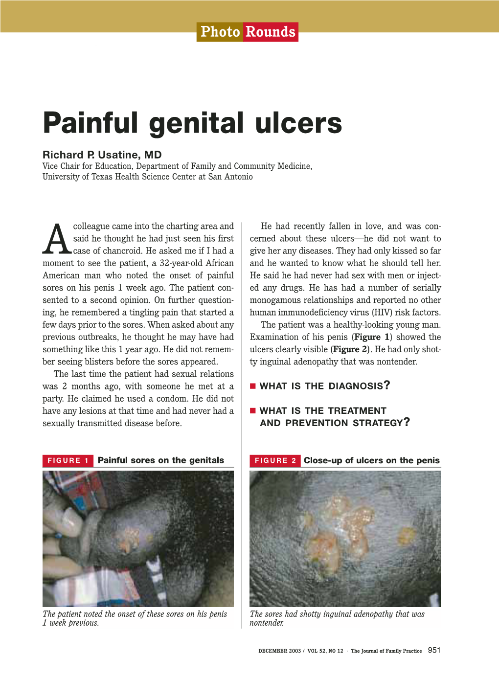 Painful Genital Ulcers