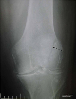 The Surgical Repair of Transverse Patella Fractures