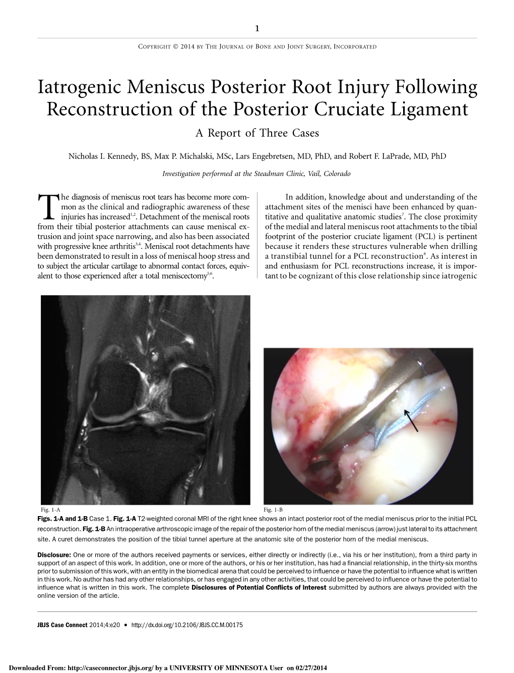 Iatrogenic Meniscus Posterior Root Injury Following Reconstruction of the Posterior Cruciate Ligament a Report of Three Cases