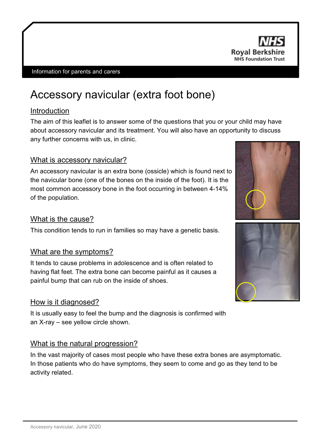 Accessory Navicular