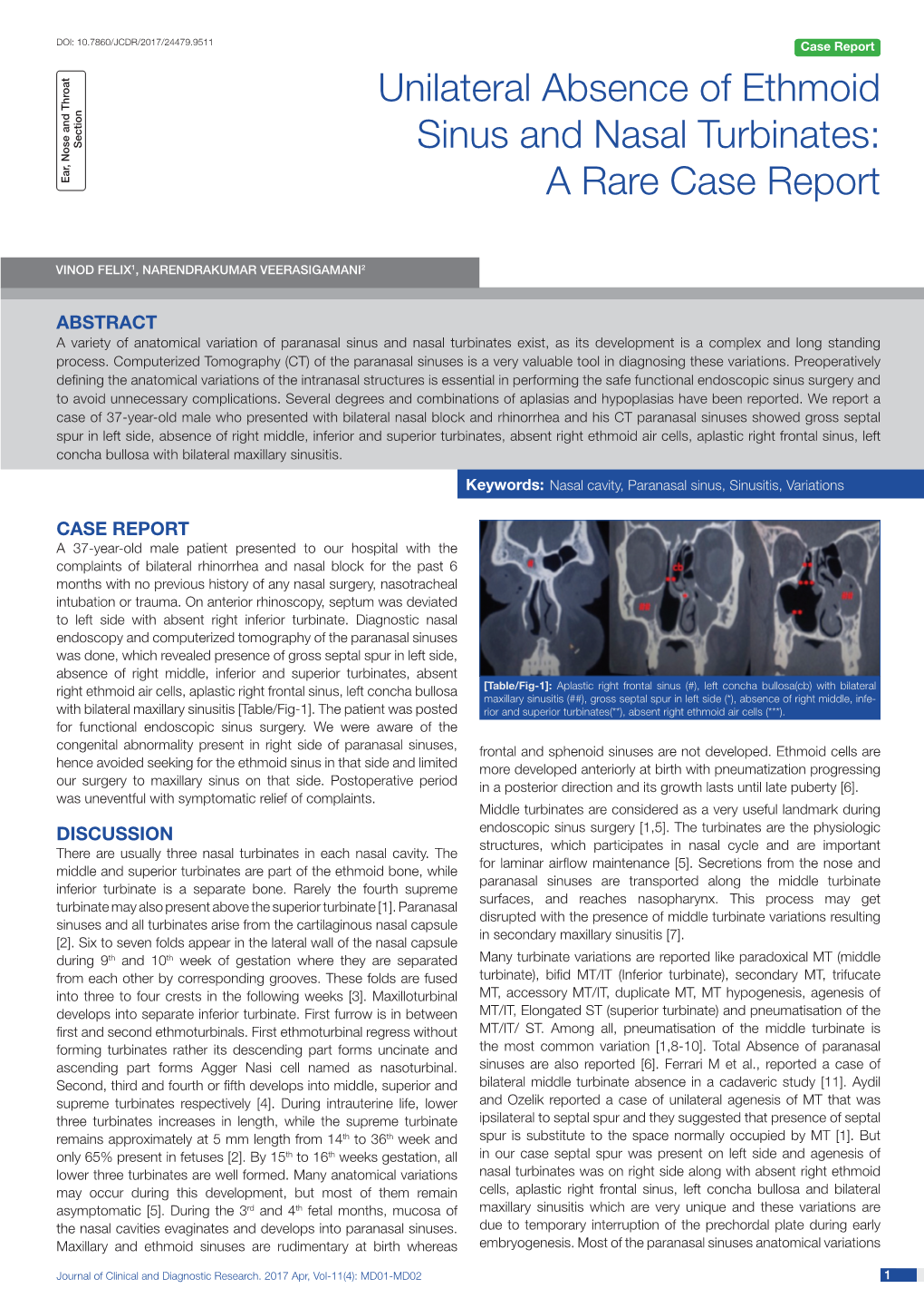 Unilateral Absence of Ethmoid Sinus and Nasal Turbinates- a Rare Case Report