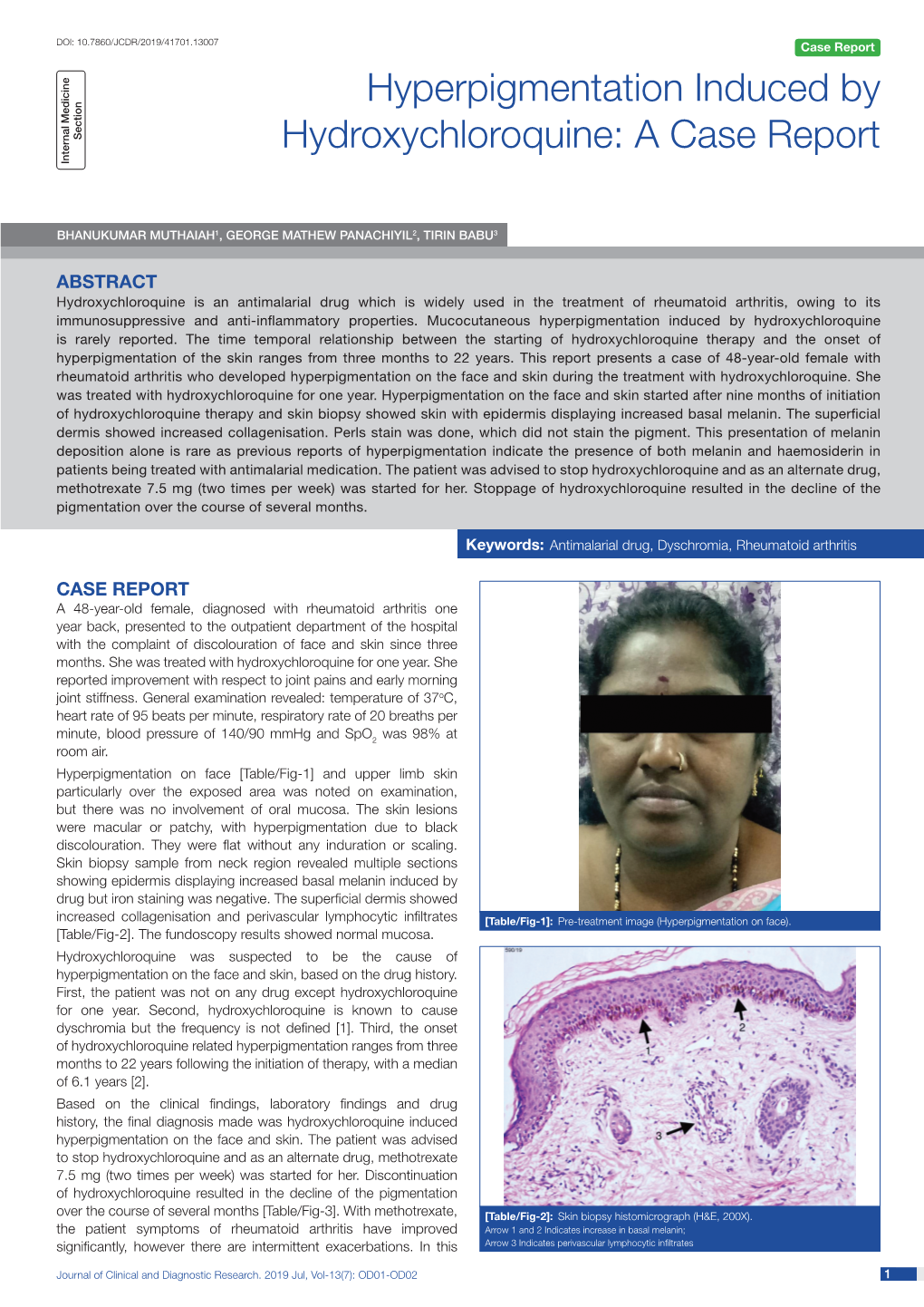 Hyperpigmentation Induced by Hydroxychloroquine: a Case Report