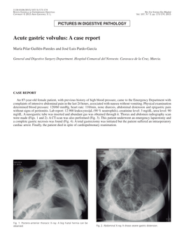 Acute Gastric Volvulus: a Case Report