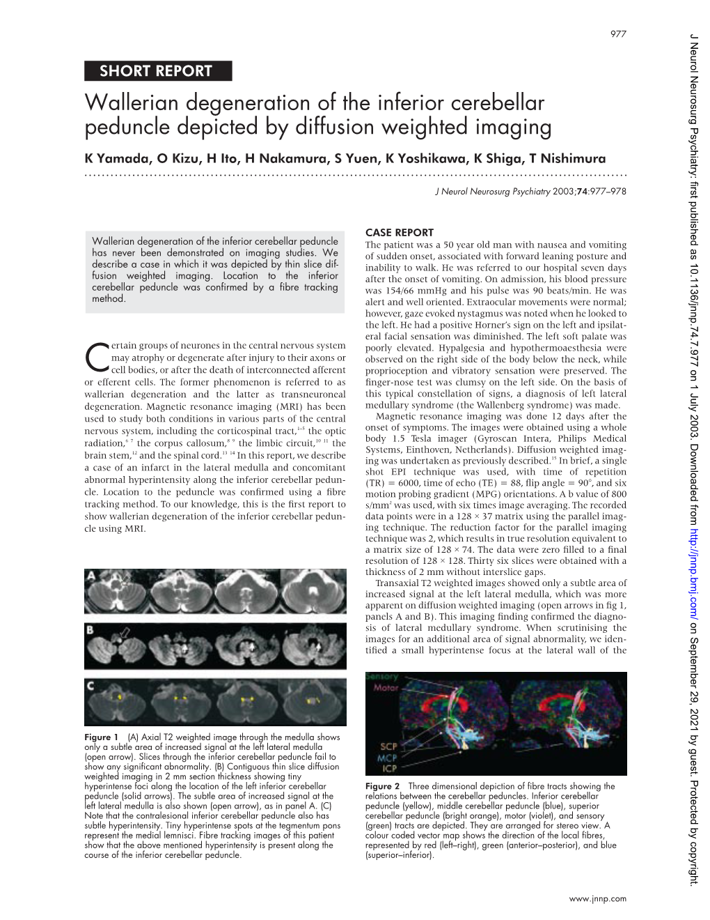 Wallerian Degeneration of the Inferior Cerebellar Peduncle Depicted By