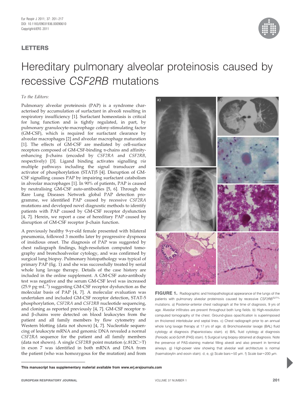 Hereditary Pulmonary Alveolar Proteinosis Caused by Recessive CSF2RB Mutations