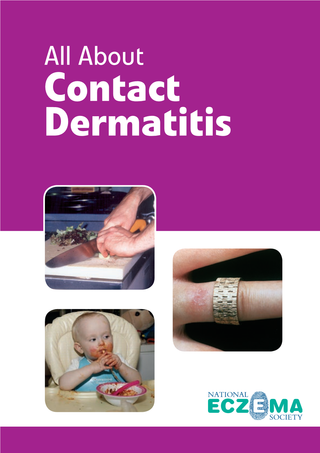 Contact Dermatitis/Eczema