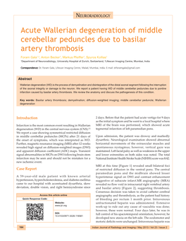 Acute Wallerian Degeneration of Middle Cerebellar Peduncles Due to Basilar Artery Thrombosis