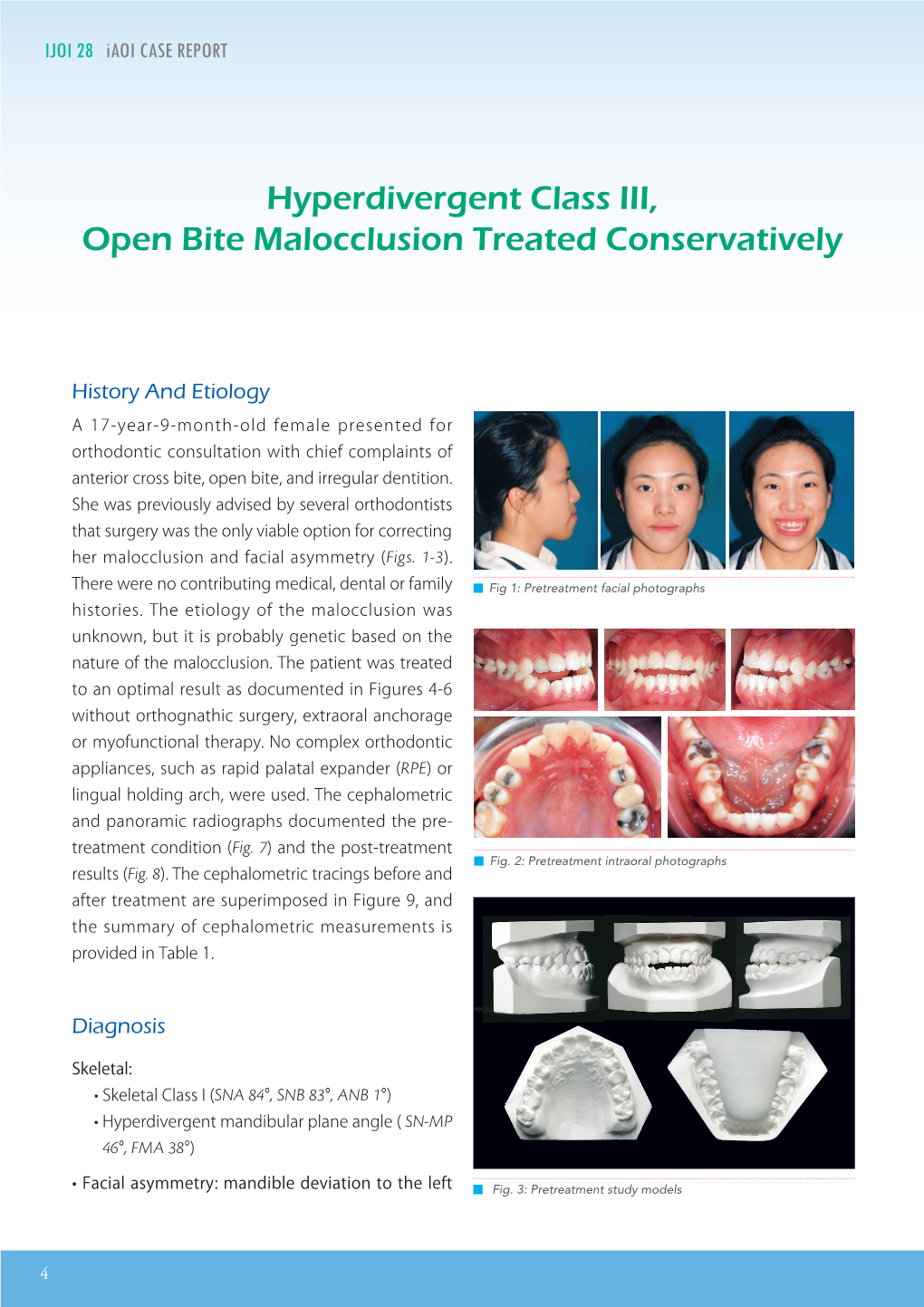 Hyperdivergent Class III, Open Bite Malocclusion Treated Conservatively