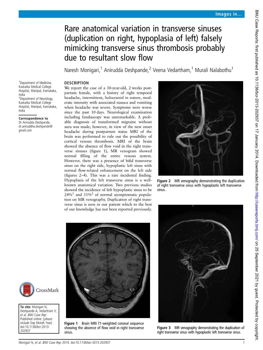 Falsely Mimicking Transverse Sinus Thrombosis Probably Due to Resultant Slow ﬂow Naresh Monigari,1 Anirudda Deshpande,2 Veena Vedartham,1 Murali Nalabothu1