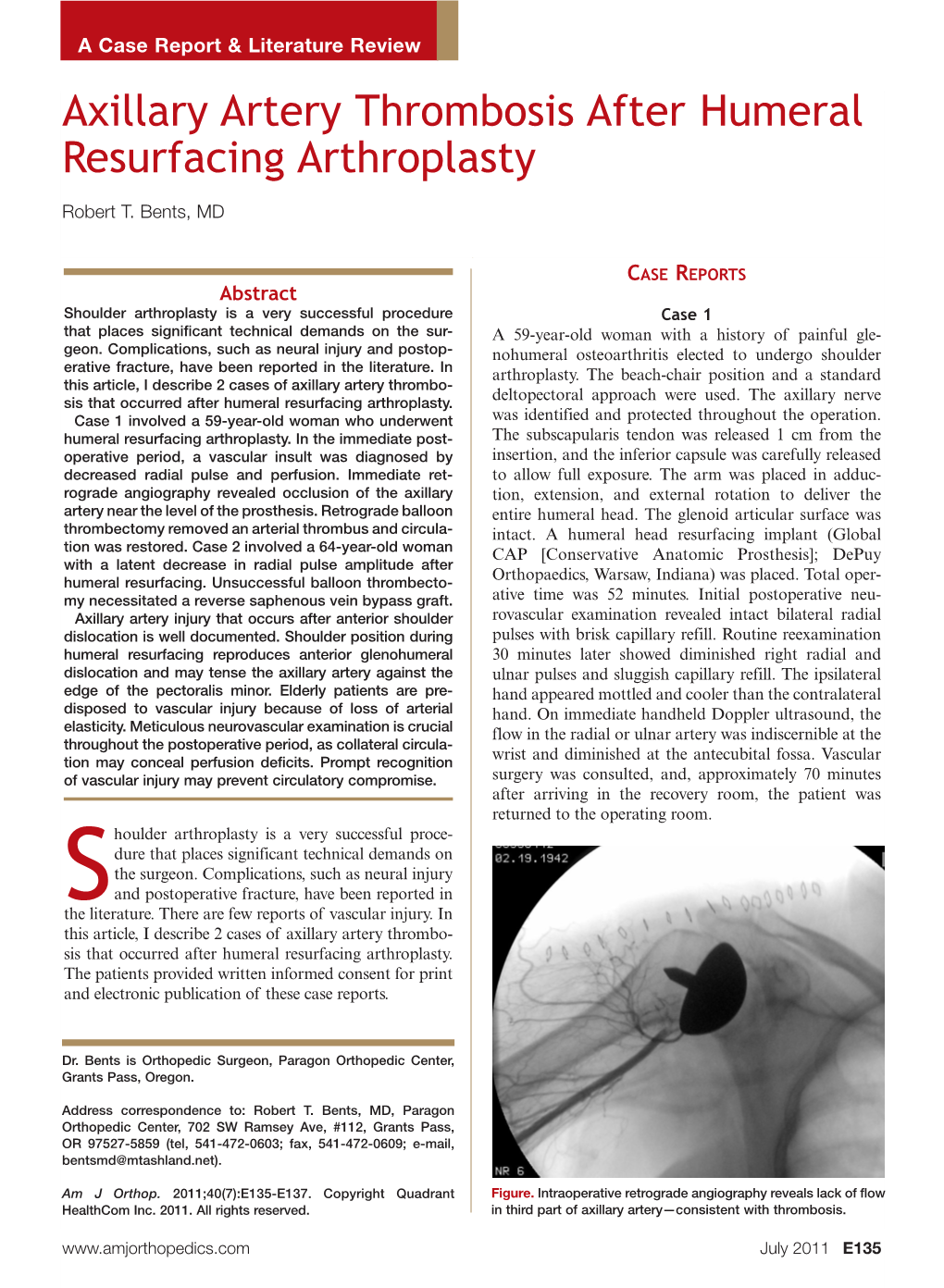 Axillary Artery Thrombosis After Humeral Resurfacing Arthroplasty