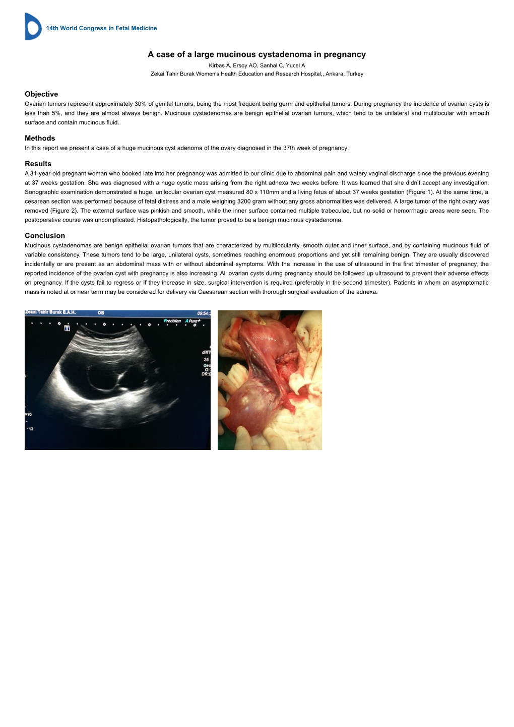 A Case of a Large Mucinous Cystadenoma in Pregnancy