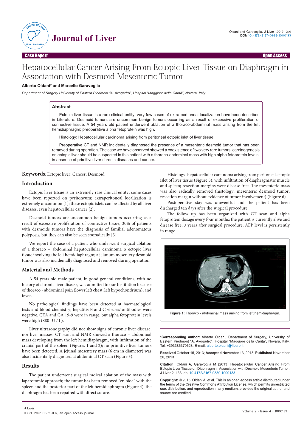 Hepatocellular Cancer Arising from Ectopic Liver Tissue on Diaphragm