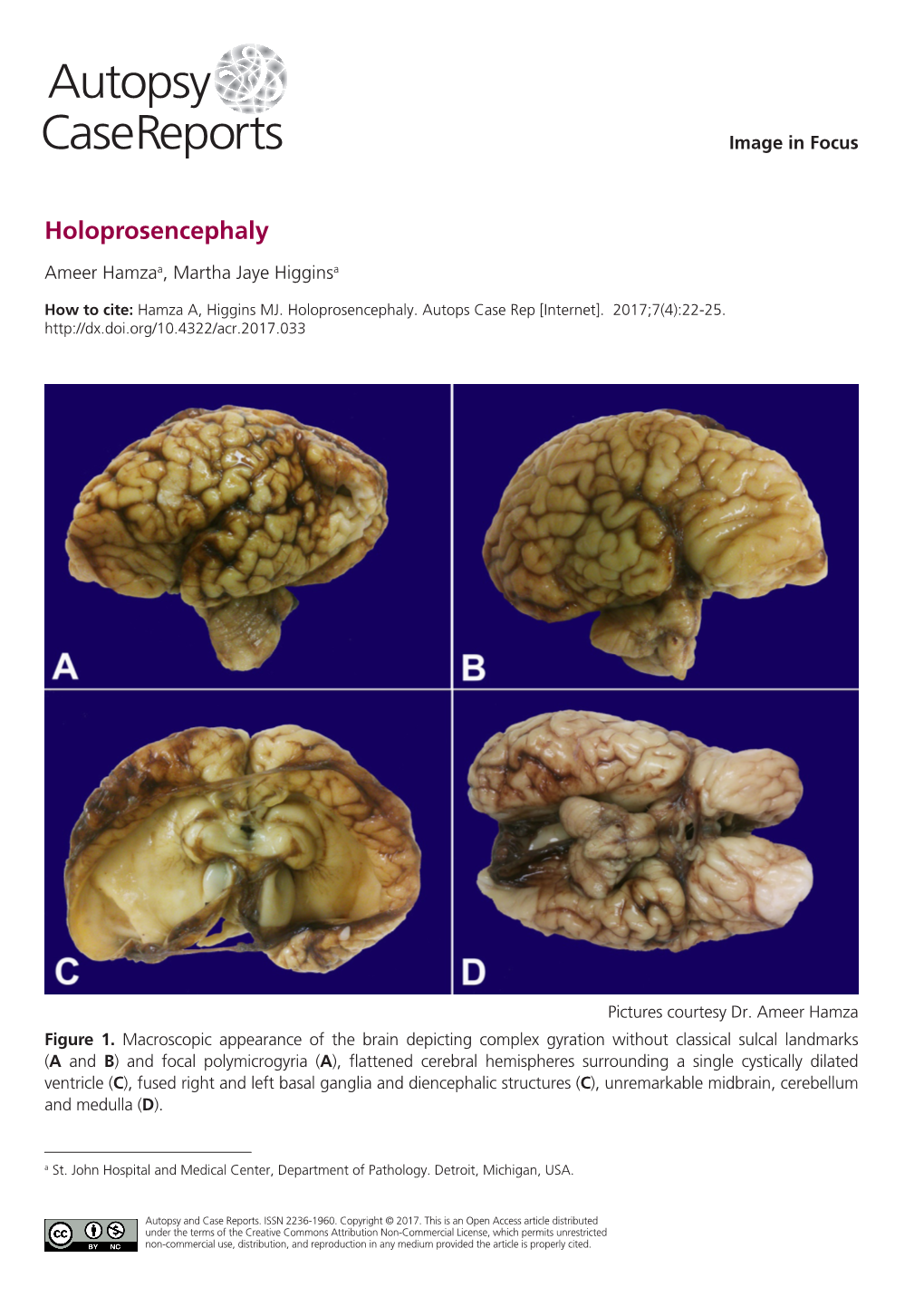 Holoprosencephaly