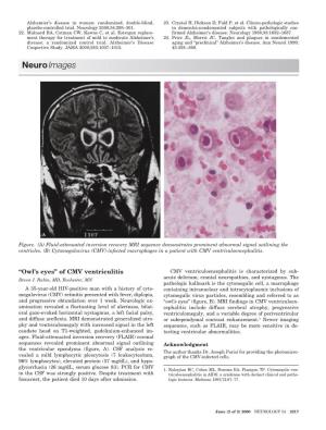 Of CMV Ventriculitis CMV Ventriculoencephalitis Is Characterized by Sub- Acute Delirium, Cranial Neuropathies, and Nystagmus