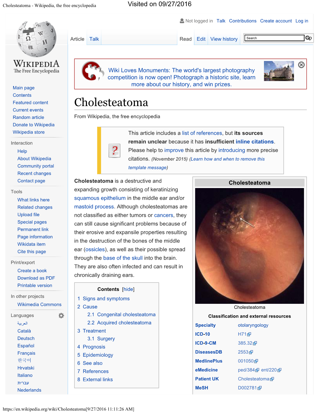 Cholesteatoma - Wikipedia, the Free Encyclopedia Visited on 09/27/2016