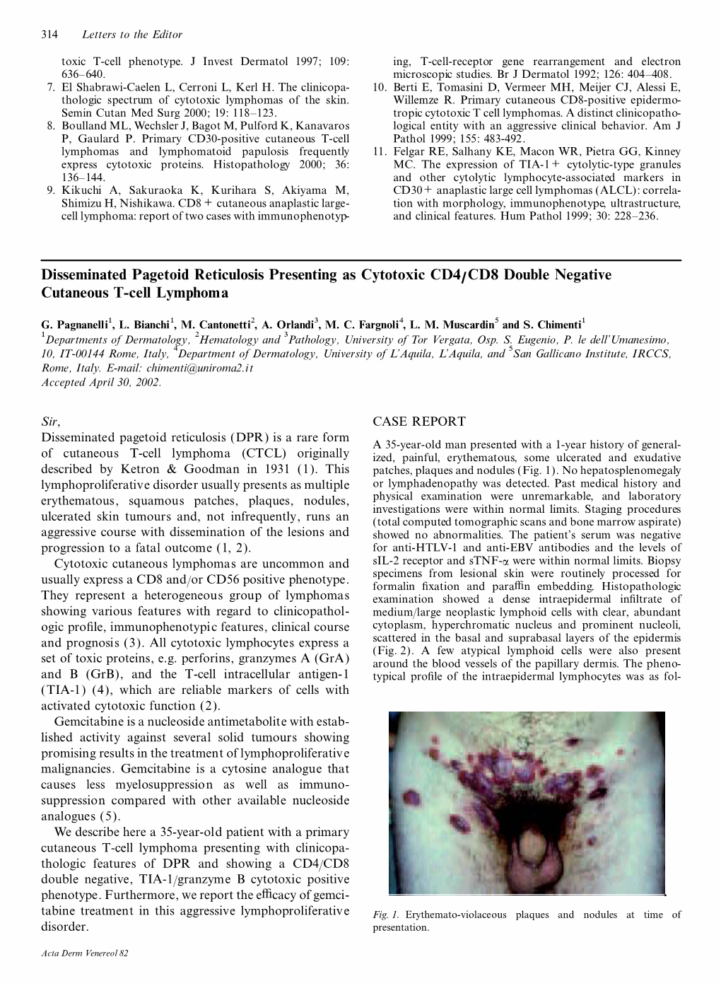 Disseminated Pagetoid Reticulosis Presenting As Cytotoxic CD4/CD8 Double Negative Cutaneous T-Cell Lymphoma