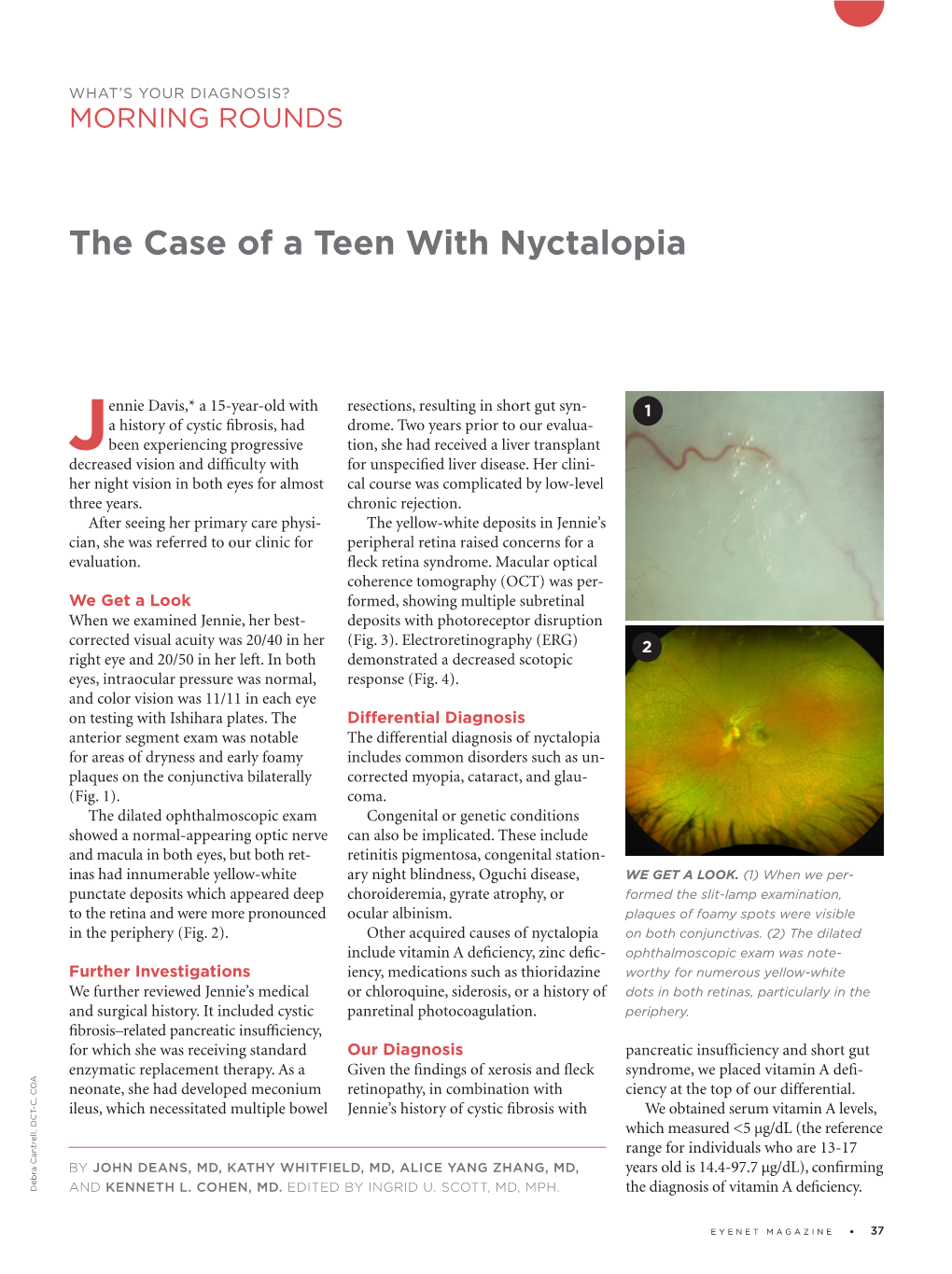 The Case of a Teen with Nyctalopia