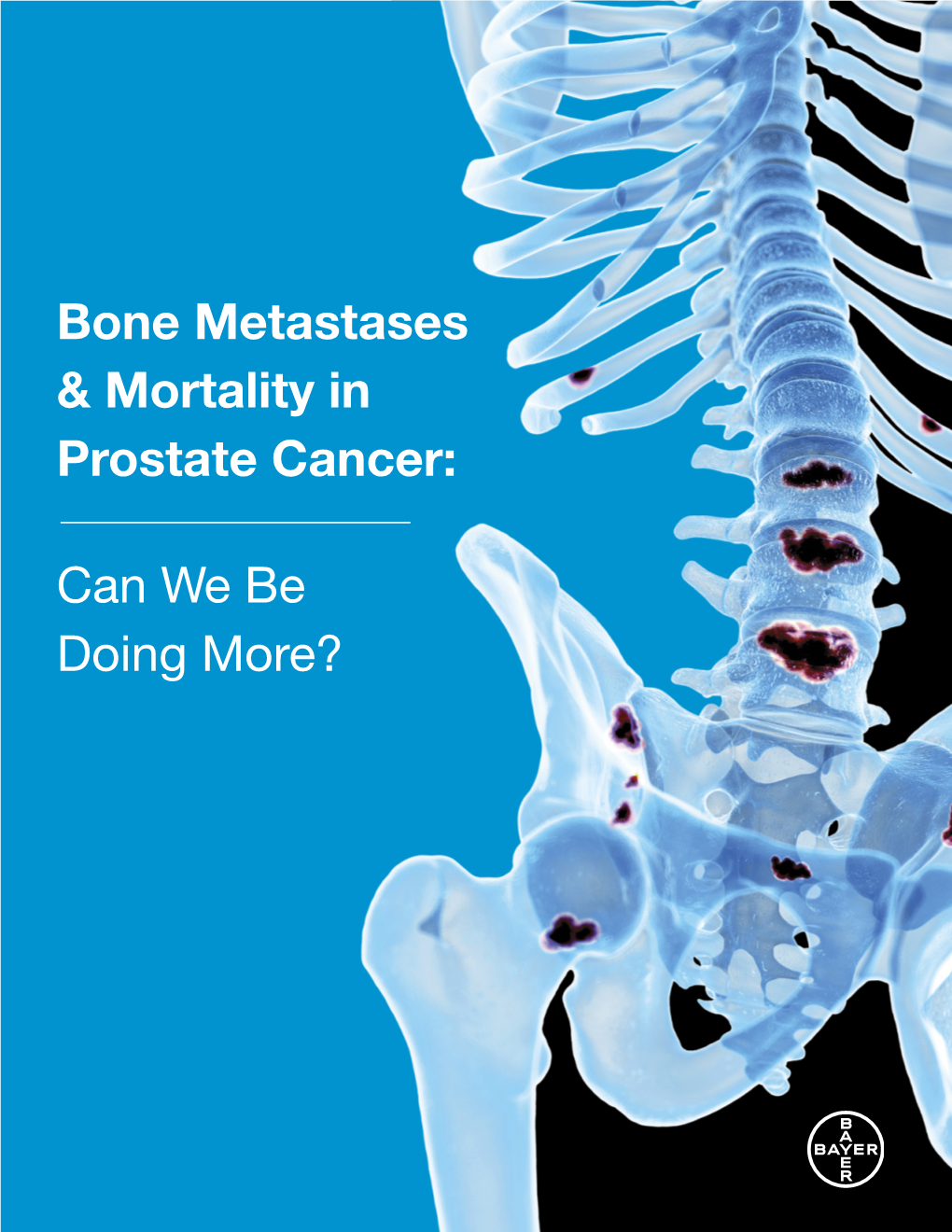 Bone Metastases & Mortality in Prostate Cancer: Can We Be Doing More?