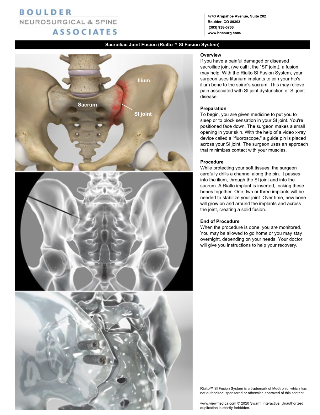 SI Joint Sacrum Ilium