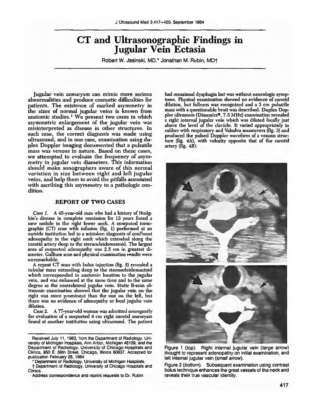 CT and Ultrasonographic Findings in Jugular Vein Ectasia