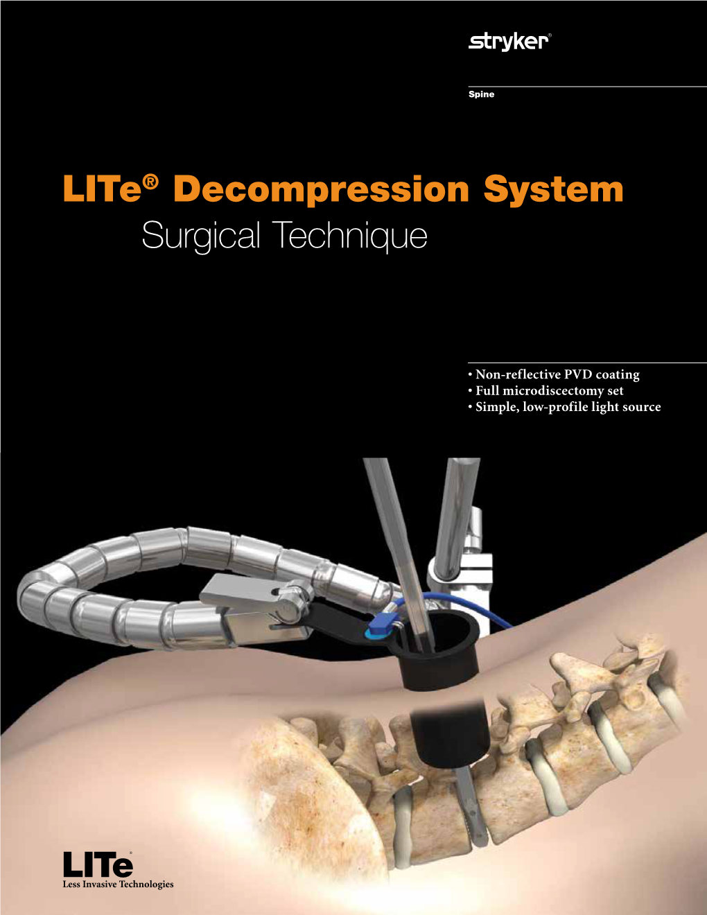 Lite® Decompression System Surgical Technique