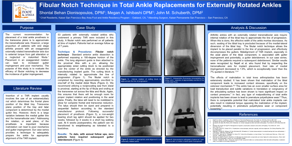 Fibular Notch Technique in Total Ankle Replacements for Externally Rotated Ankles Shontal Behan Dionisopoulos, DPM1; Megan A