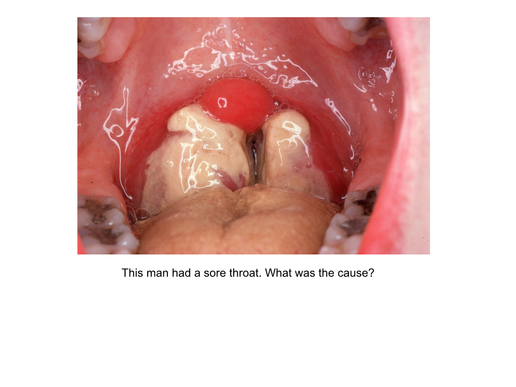 This Man Had a Sore Throat. What Was the Cause? This Is the “Ultimate Classical” Appearance of Glandular Fever