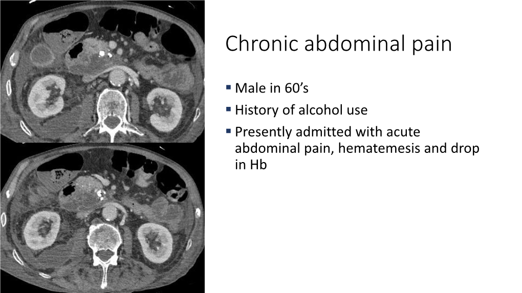 Chronic Abdominal Pain