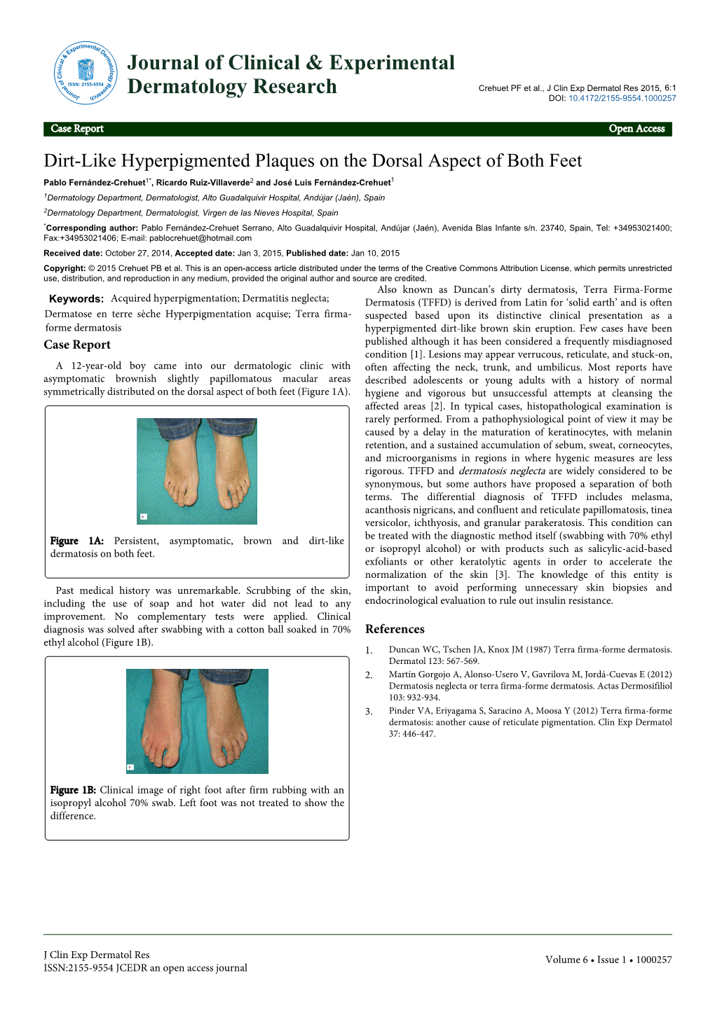 Dirt-Like Hyperpigmented Plaques on the Dorsal Aspect of Both Feet