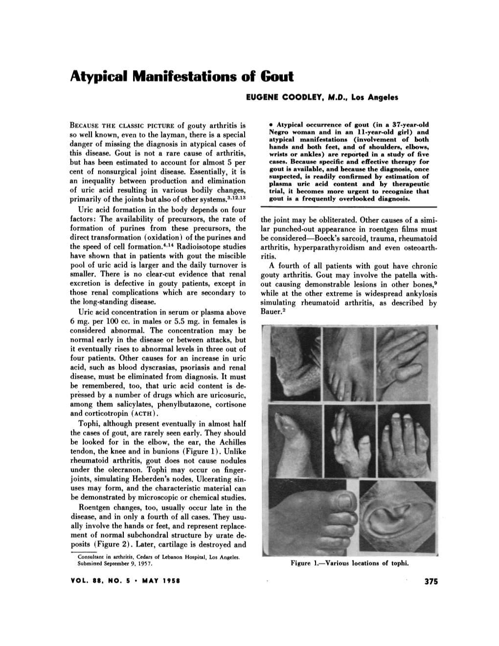 Atypical Manifestations of Gout EUGENE COODLEY, M.D., Los Angeles