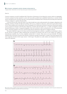 Dear Sir, Coronary Vasospasm Can Result in Tombstone-Like ST