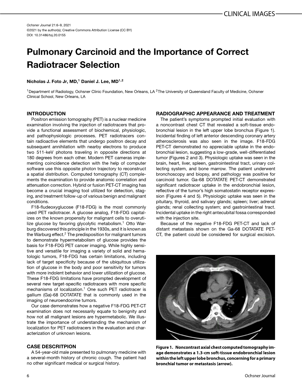 Pulmonary Carcinoid and the Importance of Correct Radiotracer Selection