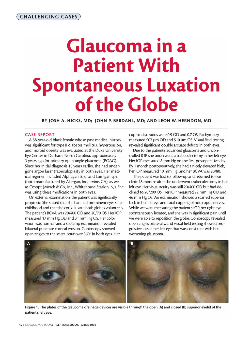 Glaucoma in a Patient with Spontaneous Luxation of the Globe by JOSH A