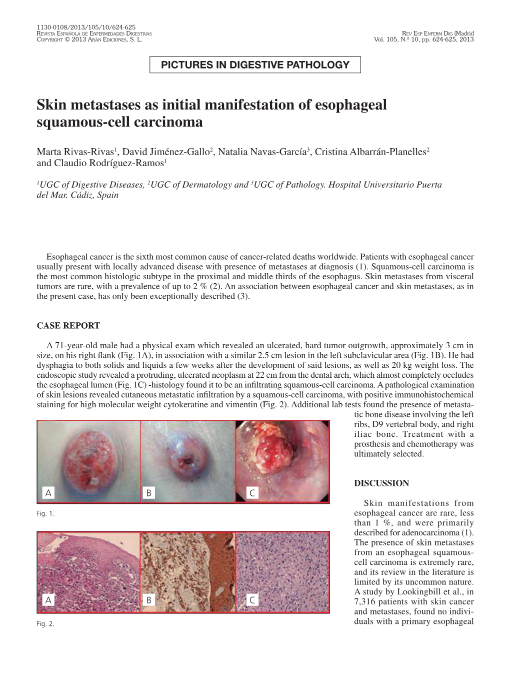 Skin Metastases As Initial Manifestation of Esophageal Squamous-Cell Carcinoma