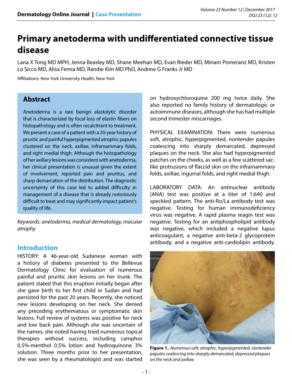 Primary Anetoderma with Undifferentiated Connective Tissue
