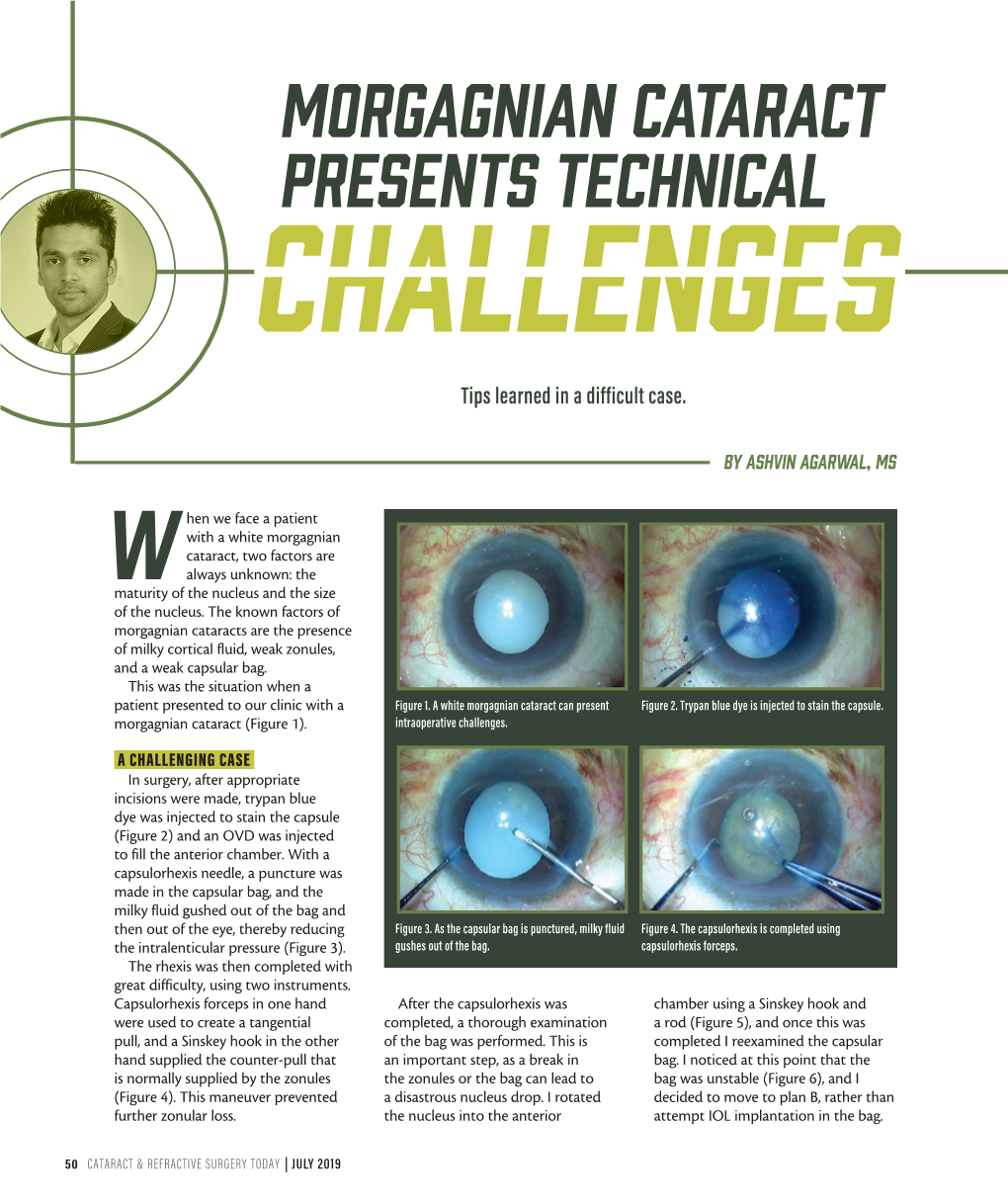 Morgagnian Cataract Presents Technical Challenges