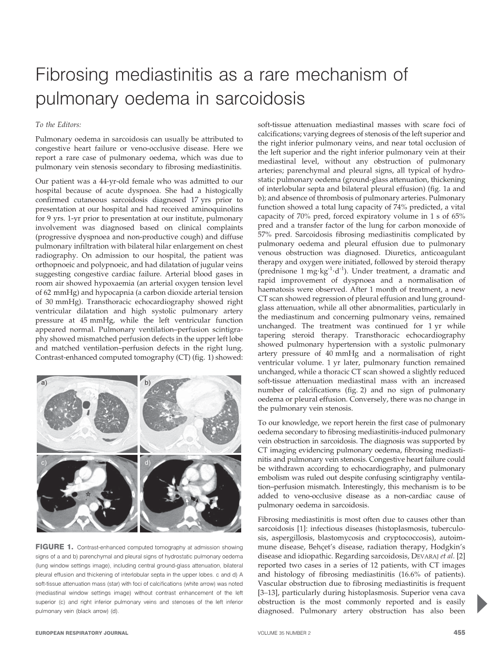 Fibrosing Mediastinitis As a Rare Mechanism of Pulmonary Oedema in Sarcoidosis