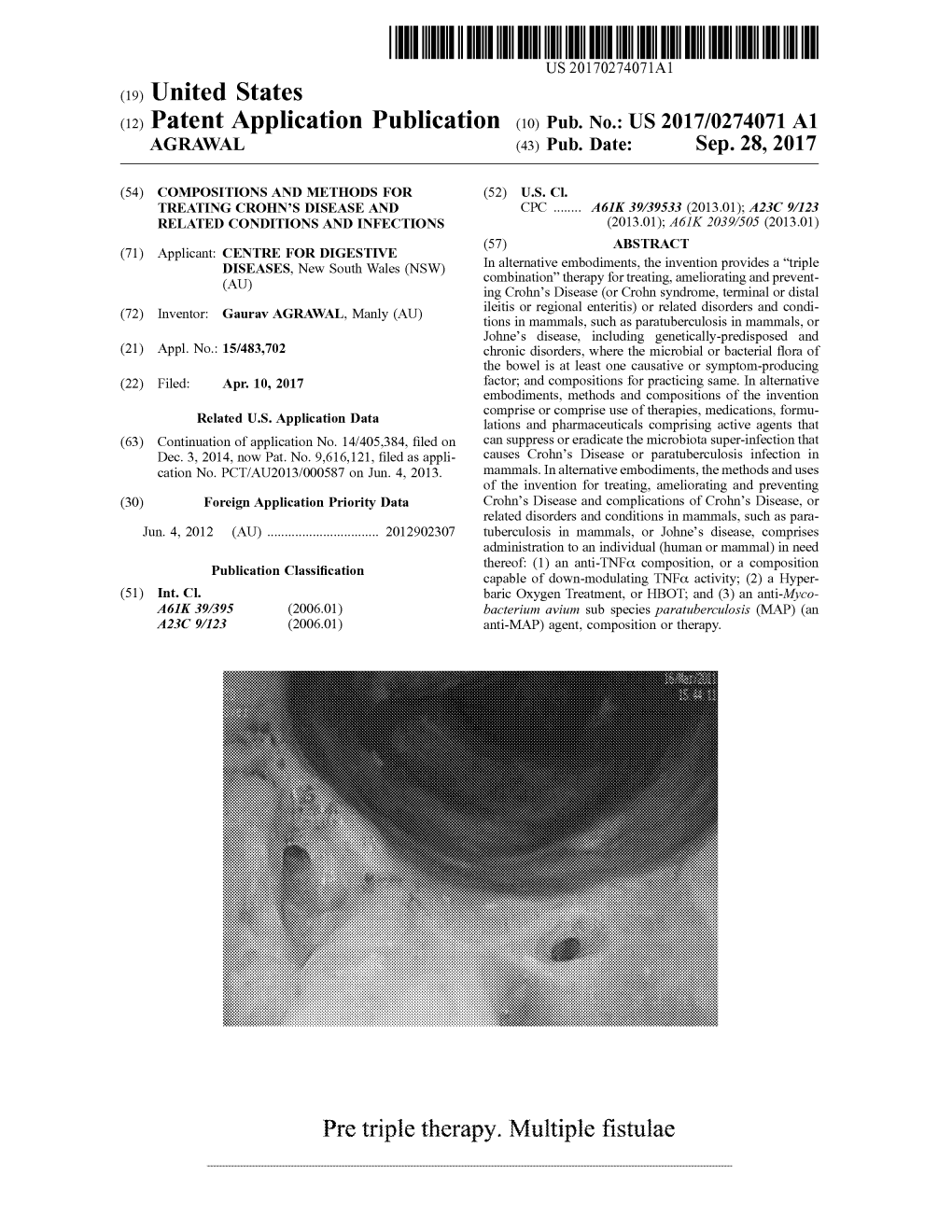 Pre Triple Therapy . Multiple Fistulae Patent Application Publication Sep