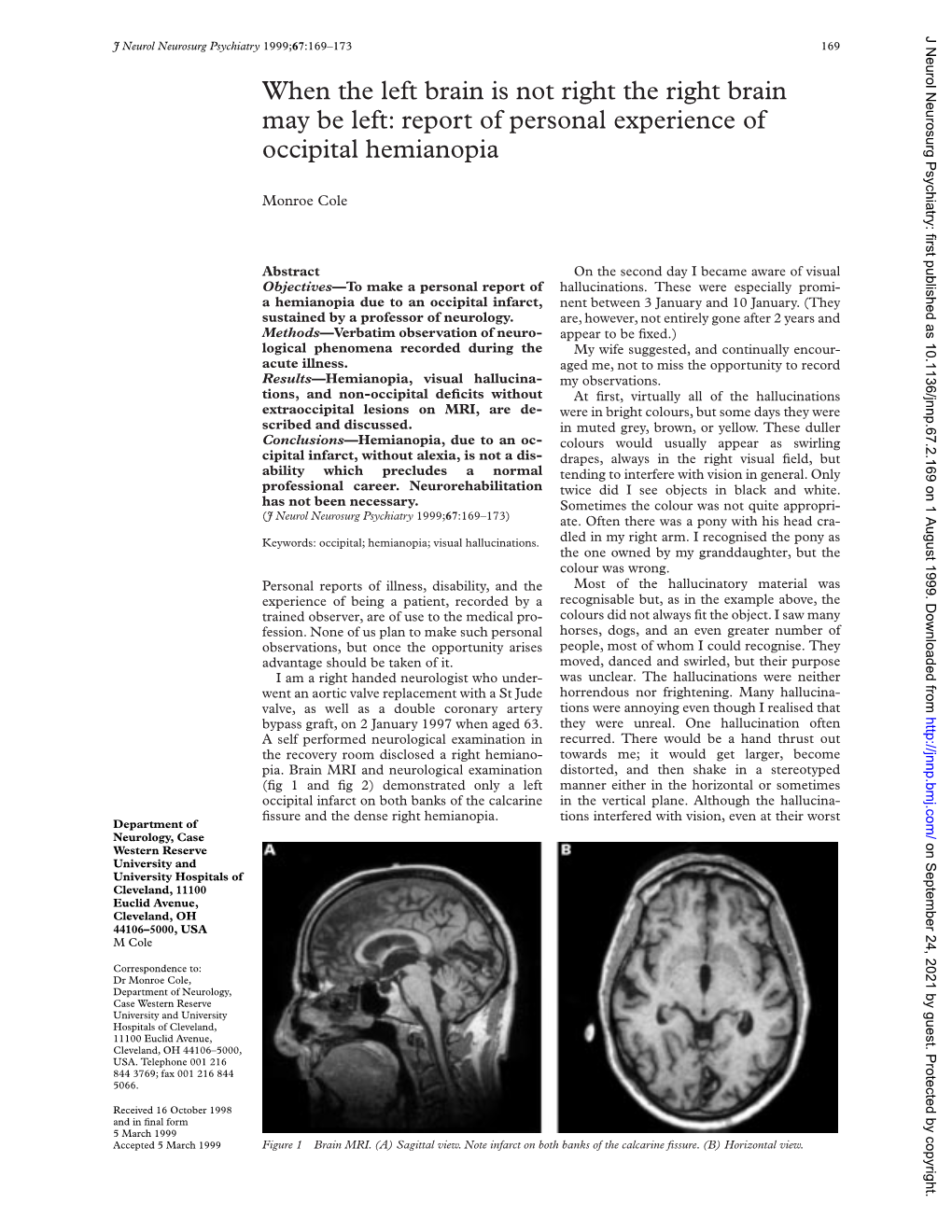 When the Left Brain Is Not Right the Right Brain May Be Left: Report of Personal Experience of Occipital Hemianopia